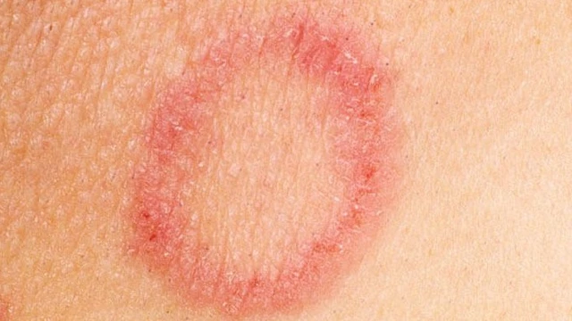 bai-viet/hac-lao-sau-gay-co-nguy-hiem-khong-cach-chua-hac-lao-tai-nha-55570.html