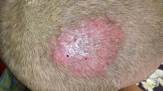 bai-viet/hac-lao-tai-phat-co-the-chua-het-duoc-khong-can-luu-y-dieu-gi-de-phong-tranh-55710.html