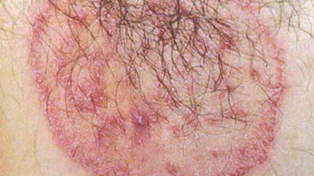 bai-viet/hac-lao-vung-kin-nam-co-nguy-hiem-khong-thuoc-dieu-tri-hac-lao-nhanh-chong-55506.html