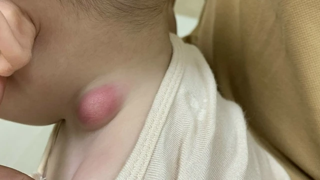 bai-viet/hach-o-co-tre-em-la-benh-gi-noi-hach-o-co-tre-co-nguy-hiem-hay-khong.html