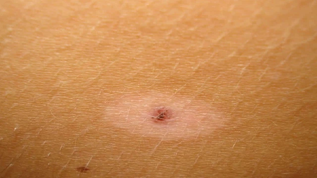 bai-viet/halo-nevus-nguyen-nhan-trieu-chung-va-cach-dieu-tri.html