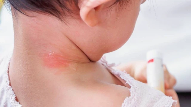 bai-viet/ham-co-la-gi-be-bi-ham-co-boi-thuoc-gi-62372.html