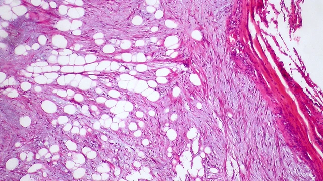 bai-viet/hamartoma-la-gi-cac-loai-hamartoma-pho-bien.html