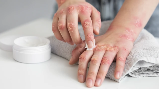 bai-viet/benh-thuy-dau-lay-qua-duong-nao-bien-phap-de-phong-ngua-benh-thuy-dau.html