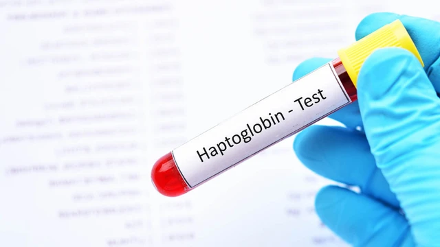 Haptoglobin là gì? Yếu tố có thể ảnh hưởng đến kết quả haptoglobin