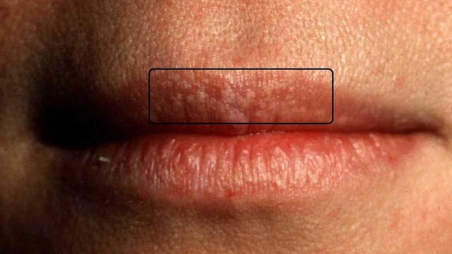 bai-viet/hat-fordyce-co-tu-khoi-khong-va-nhung-cach-dieu-tri-hieu-qua-nhat.html