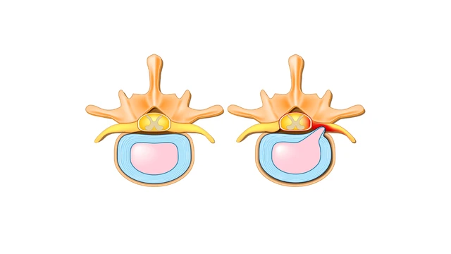 Hẹp lỗ liên hợp đốt sống cổ