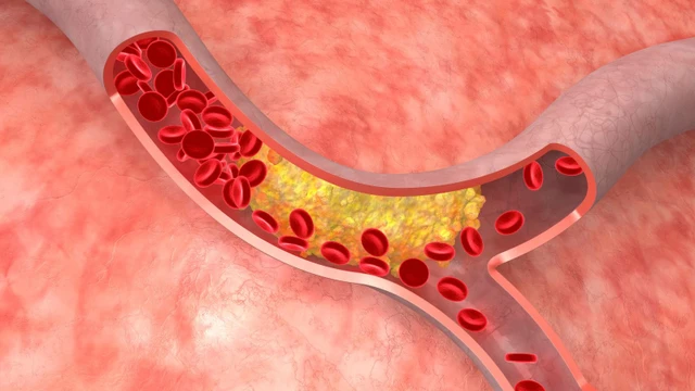 bai-viet/hep-mach-vanh-60-la-muc-do-nang-hay-nhe-can-dat-stent-chua.html