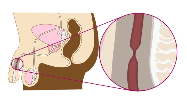 Hẹp niệu đạo: Triệu chứng, nguyên nhân, chẩn đoán và điều trị 1