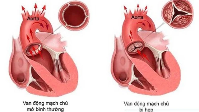 bai-viet/hep-van-dong-mach-chu-nguyen-nhan-trieu-chung-va-cach-dieu-tri.html