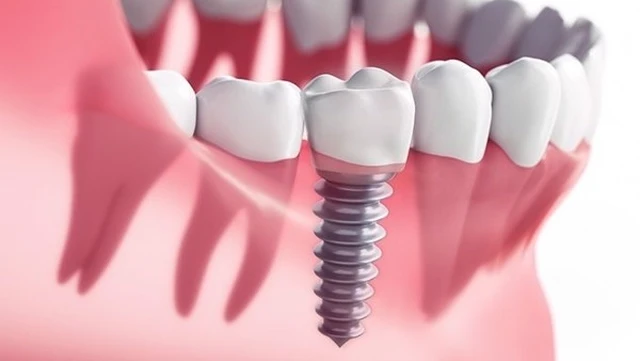 bai-viet/hieu-ro-ve-cau-tao-implant-trong-phuc-hoi-rang.html