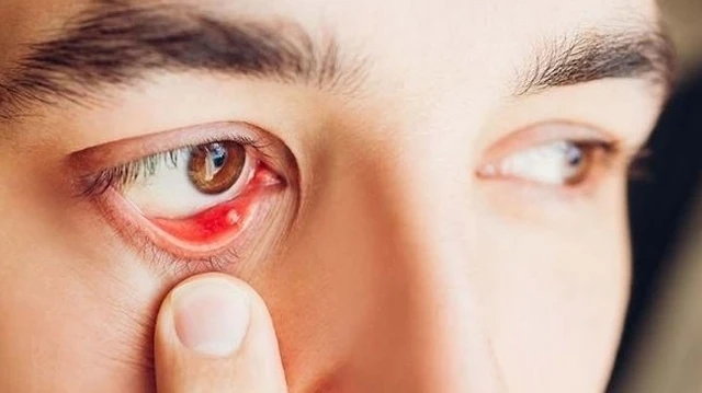 bai-viet/hieu-ro-ve-san-voi-o-mat-va-cach-phong-va-tri-benh-62633.html