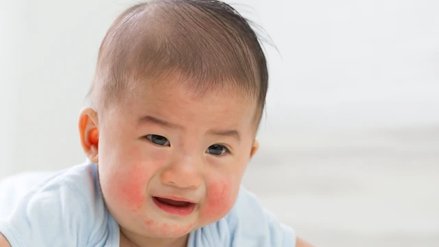 bai-viet/hinh-anh-be-bi-di-ung-dam-sua-bo-va-cach-khac-phuc-tinh-trang-nay.html