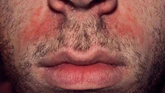 bai-viet/hinh-anh-benh-nam-da-mat-dau-hieu-nhan-biet-benh-nam-da-mat.html