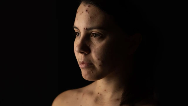 bai-viet/hinh-anh-benh-thuy-dau-o-nguoi-lon-the-nao-nhan-biet-de-dieu-tri-som.html