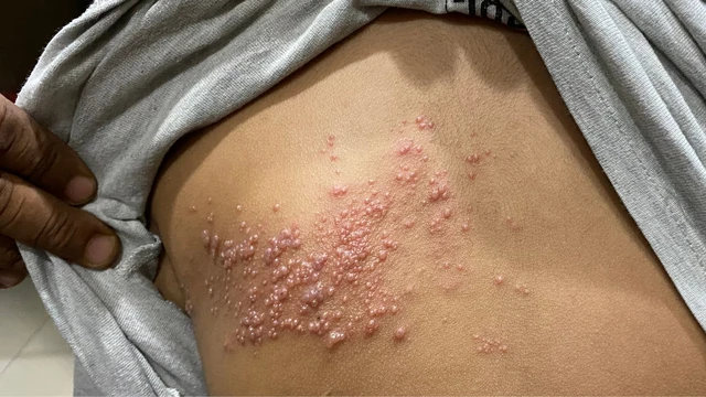 bai-viet/hinh-anh-bi-gioi-leo-qua-cac-giai-doan-cua-benh.html