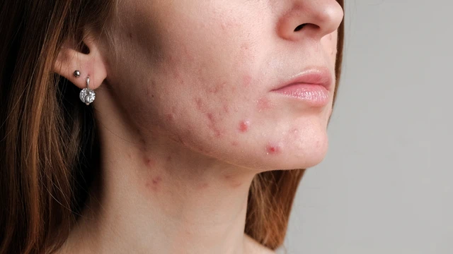 bai-viet/hinh-anh-cac-loai-mun-khac-nhau-va-cach-dieu-tri-hieu-qua.html