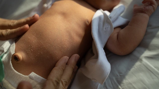 bai-viet/hinh-anh-ron-loi-o-tre-so-sinh-va-khi-nao-can-dua-be-di-kham.html