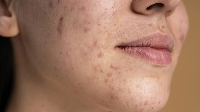 bai-viet/hiruscar-co-tri-seo-tham-khong-va-nen-dung-dong-san-pham-nao-65441.html