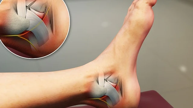 bai-viet/hoi-chung-ong-co-chan-la-gi-nguyen-nhan-dau-hieu-nhan-biet-va-cach-phong-ngua-benh.html