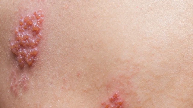 bai-viet/benh-zona-bao-nhieu-ngay-thi-khoi-dieu-tri-zona-than-kinh-nhu-the-nao-de-nhanh-khoi.html