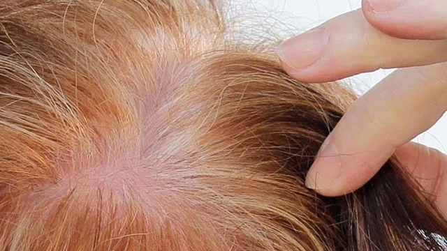 bai-viet/hoi-dau-o-nu-nguyen-nhan-dieu-tri-va-nhung-dieu-can-biet.html