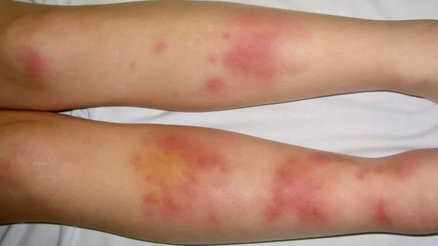 bai-viet/nguoi-mac-benh-hong-ban-nut-kieng-an-gi-la-tot-nhat.html