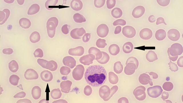 Hồng cầu hình bia là gì? Dấu hiệu cảnh báo vấn đề sức khỏe nào?