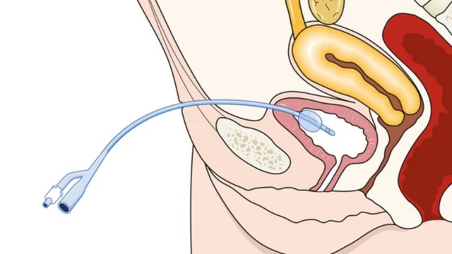 bai-viet/huong-dan-cach-dat-ong-thong-tieu-nu-gioi.html