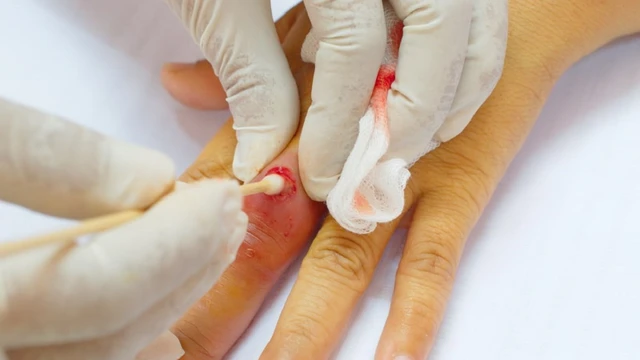 bai-viet/huong-dan-cach-rua-vet-thuong-ap-xe-tai-nha-va-mot-so-luu-y.html