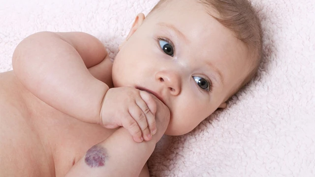 bai-viet/tham-khao-cach-tri-buou-mau-tai-nha-cho-tre.html