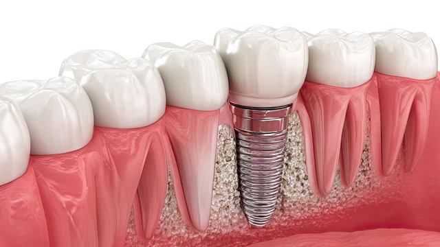 bai-viet/huong-dan-cham-soc-rang-sau-khi-cam-implant-va-luu-y-khi-thuc-hien.html