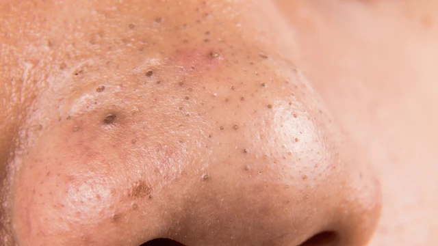 bai-viet/huong-dan-nan-mun-dau-den-o-mui-dung-cach-tai-nha.html