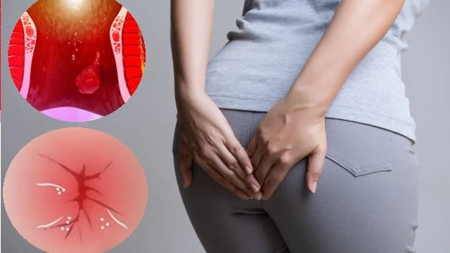 bai-viet/huong-dan-nhan-biet-hau-mon-binh-thuong-va-hau-mon-bi-tri.html