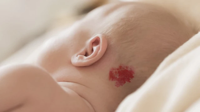 bai-viet/huong-dan-phan-biet-buou-mau-va-buou-huyet-thanh.html