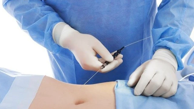 bai-viet/hut-mo-bung-khong-phau-thuat-la-gi-nhung-dieu-can-luu-y-truoc-khi-thuc-hien.html