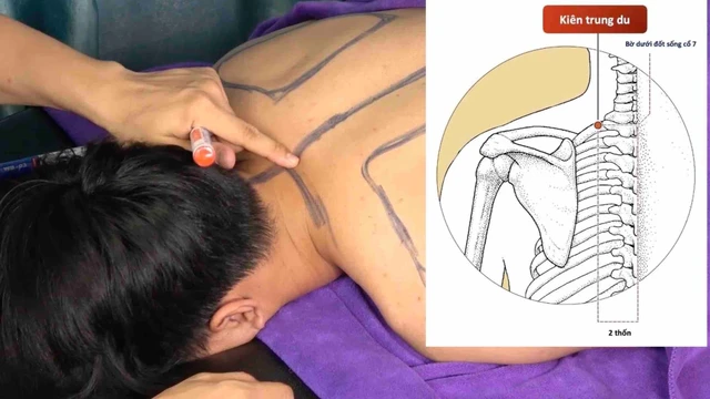 bai-viet/huyet-kien-trung-du-la-gi-cach-xac-dinh-vi-tri-huyet-kien-trung-du.html