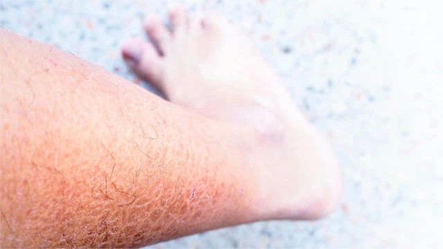 bai-viet/ichthyosis-la-gi-nguyen-nhan-trieu-chung-va-cach-dieu-tri.html