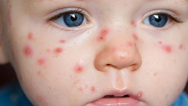 bai-viet/tim-hieu-thong-tin-be-bi-noi-man-do-co-mu-la-do-dau.html