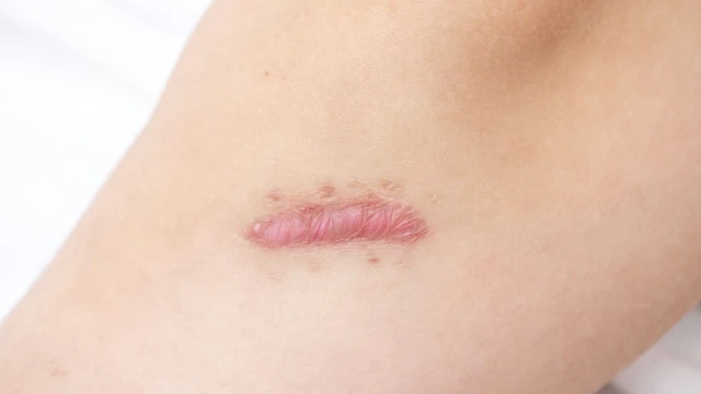 bai-viet/keloid-la-gi-nguyen-nhan-hinh-thanh-va-cach-khac-phuc.html