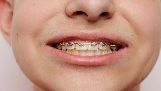 bai-viet/keo-cum-4-rang-cua-mat-bao-lau-giai-dap-chinh-xac.html