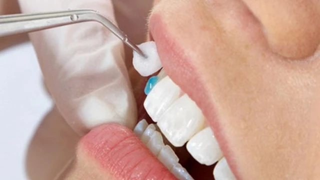 bai-viet/keo-dan-rang-su-la-gi-nhung-loai-rang-su-dang-duoc-ua-chuong-64603.html