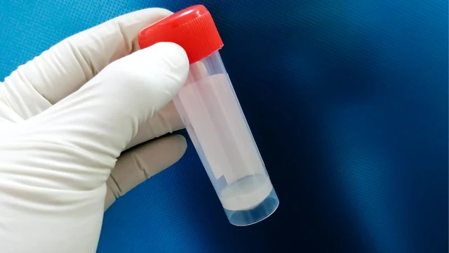 Kết quả tinh dịch đồ thế nào là yếu? Nguyên nhân dẫn đến tình trạng tinh dịch đồ yếu