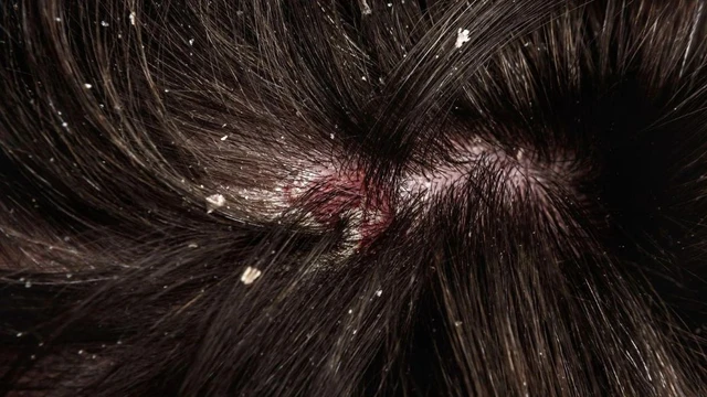 bai-viet/khac-phuc-nam-da-dau-voi-dau-goi-nazorel-shampoo-ciclopirox-olamine.html