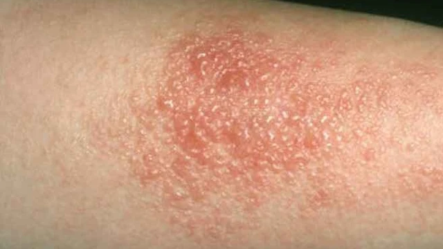 bai-viet/khi-bi-gioi-leo-boi-thuoc-gi-de-dieu-tri-hieu-qua.html