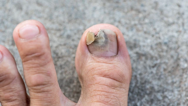 bai-viet/khi-mong-chan-bi-nam-co-moc-lai-khong-cach-cham-soc-mong-giup-giam-nguy-co-tai-phat-nam-sau-dieu-tri.html