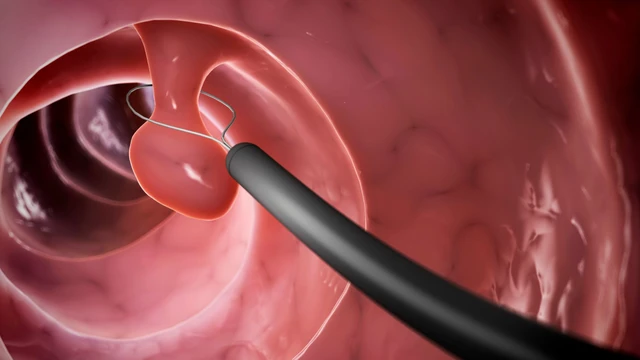 bai-viet/khi-nao-can-cat-polyp-da-day-qua-noi-soi-can-luu-y-gi-khi-cat-polyp-da-day.html