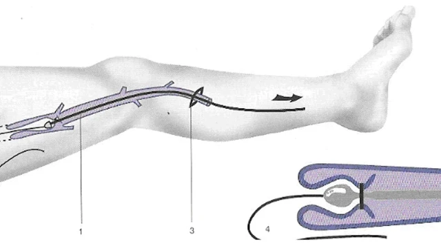 bai-viet/khi-nao-can-dieu-tri-suy-gian-tinh-mach-cac-phuong-phap-dieu-tri-hien-nay.html