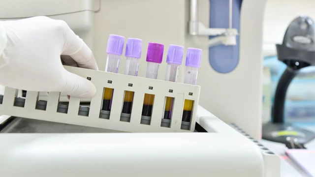 bai-viet/khi-nao-nen-xet-nghiem-tong-phan-tich-te-bao-mau-ngoai-vi.html