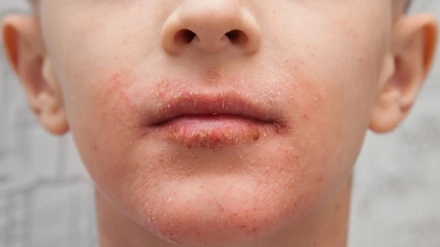 bai-viet/kho-da-quanh-mieng-nguyen-nhan-trieu-chung-cach-khac-phuc.html